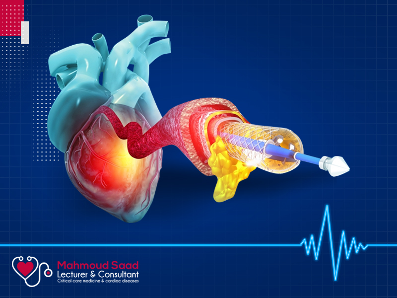 القسطرة التشخيصية للقلب مع د. محمود سعد